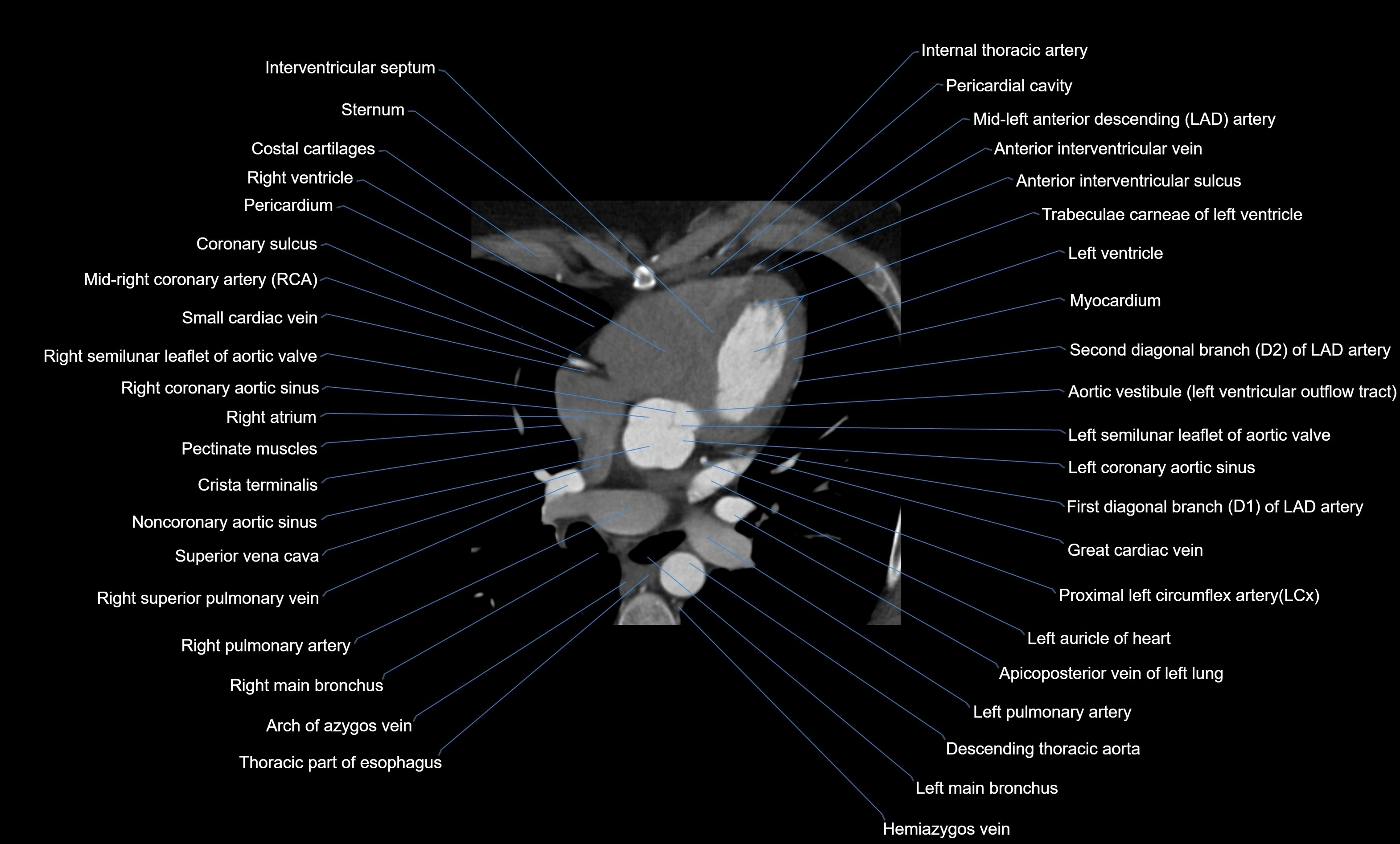CT heart (coronary angiogram) four chamber view  cross sectional anatomy labelled radiology image -00022.webp